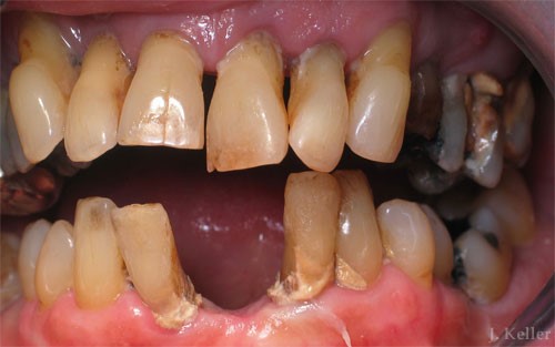 Before And After 
      Dentures Chester UT 84623